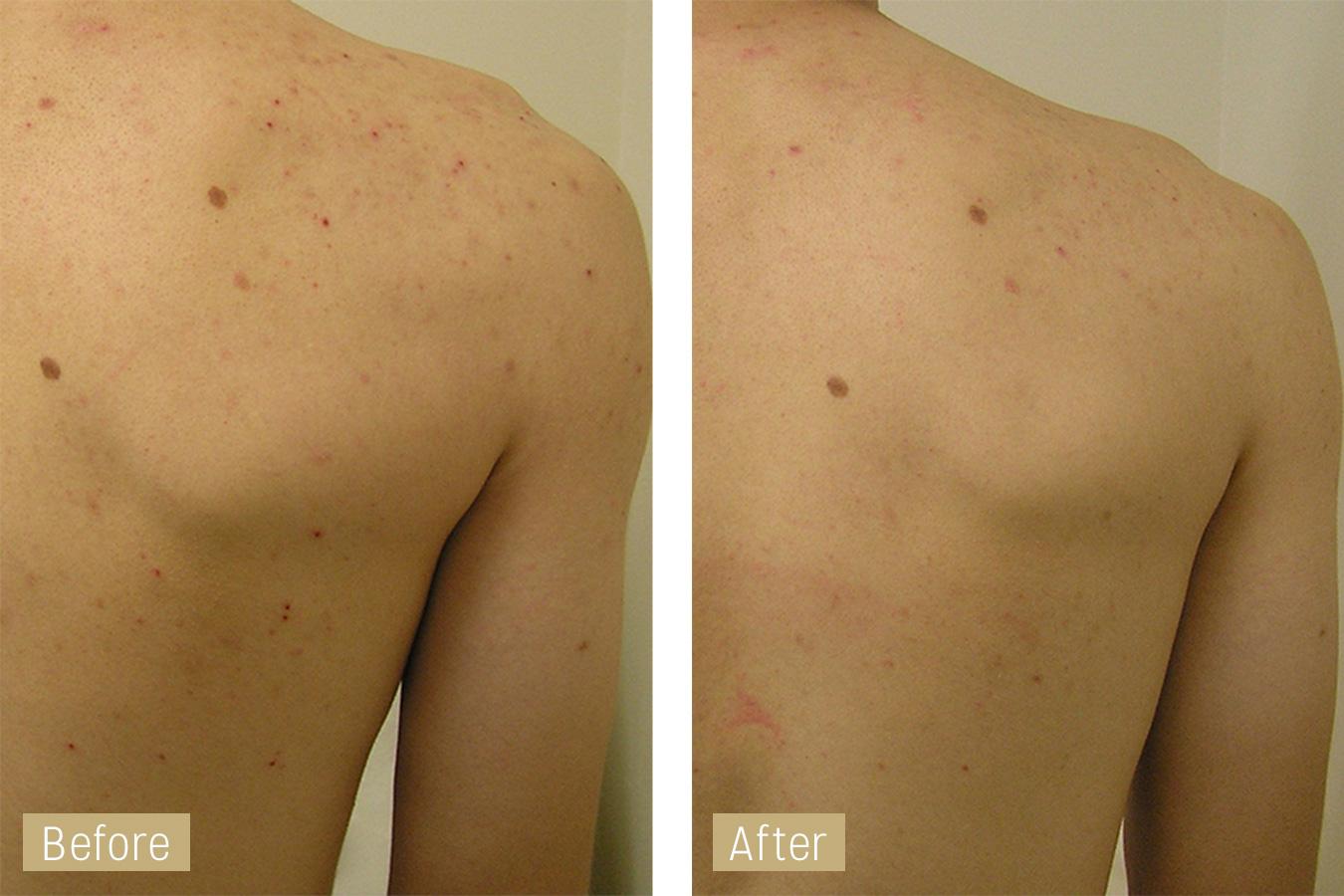 Antes y después de una limpieza de espalda con acné en Clínica Alicia Forcada, Almazora